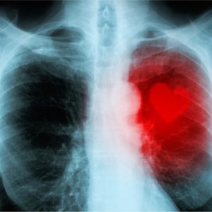 cardiomyopathy heart disease