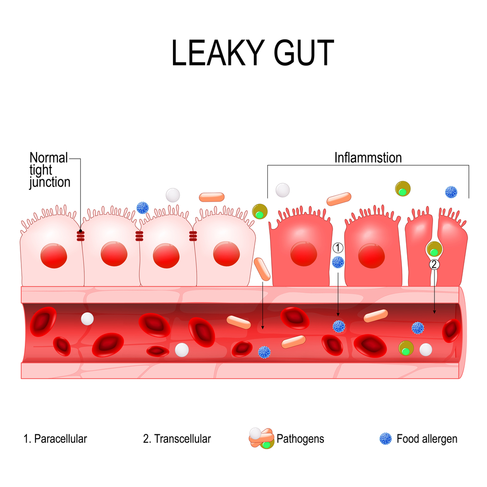 Can a Leaky Gut Lead to an Autoimmune Condition