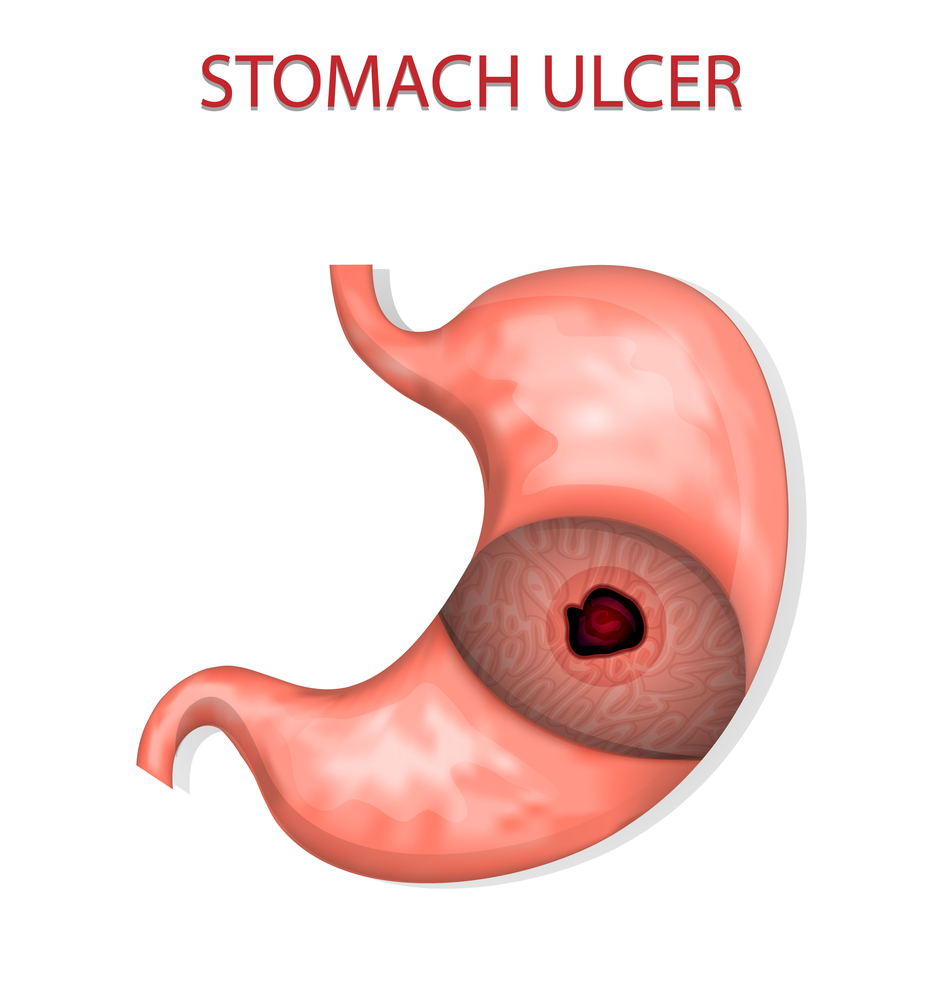 stomach ulcers